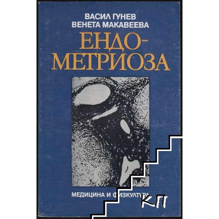 Ендометриоза, Гунев 1985г.