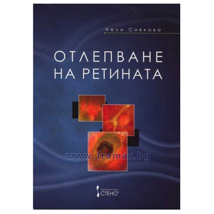 Отлепване на ретината Сивкова