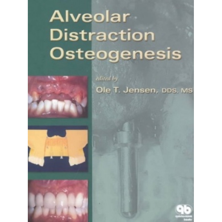 Alveolar Distraction Osteogenesis